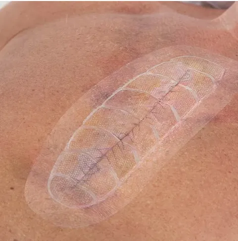 Leukomed® Control, 5cm x 7,2cm (10ks v balení)