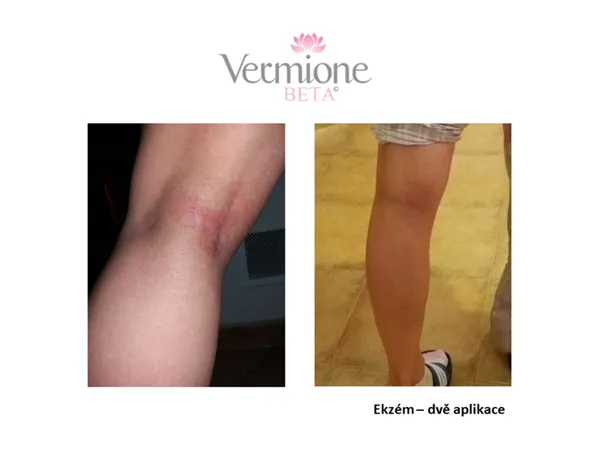 Vermione BETA regenerační a pěstící krém