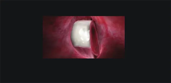 RAPID RHINO nosní tamponáda NASASTENT